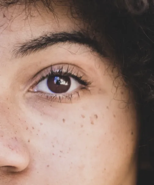 TraumaSolutions Close-up of the left side of a person's face, focusing on the eye and eyebrow, with visible freckles and curly hair—perfect for illustrating Brainspotting techniques in a masterclass for clinicians working with what arises.